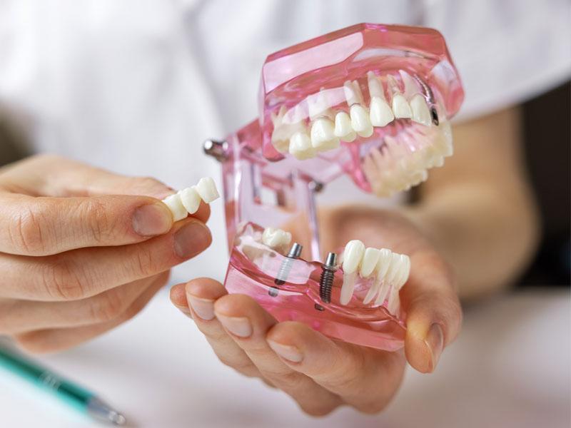 Model of dental implant